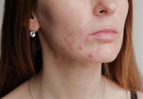 Does Stress Cause Acne Proven Investigates Dermaquip