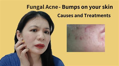 Fungal Acne Treatments And Safe Products Youtube