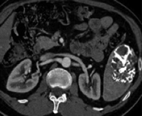 Calcified Splenic Lesions Pattern Recognition Approach On Ct With