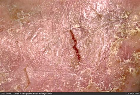 Stock Image Dermatology Pompholyx Eczema Very Dry Cracked And Peeling