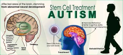 Stem Cell Treatment For Autism Best Autism Treatment Center In India