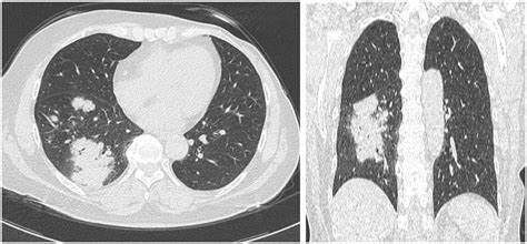 Clinical Features And Radiological Characteristics Of Pulmonary