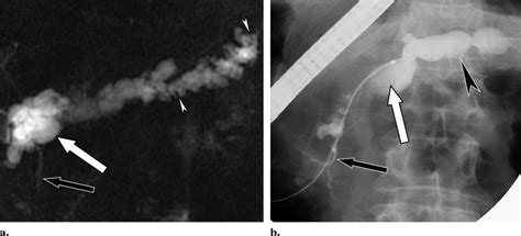 Ipmt With Diffuse Duct Disease A Postsecretin Mr Image Shows Severe