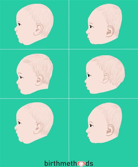 How Craniosynostosis Can Improve Your Babys Head Shape