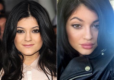 kylie jenner admits she has lip fillers worldwrapfederation