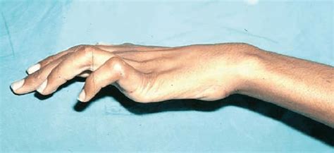 Hand With Ulnar Claw Due To Neuritis In Leprosy Download Scientific