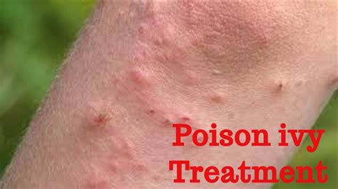 Best Home Treatment For Poison Ivy On NIGHT Cure Itchy Skin Rash Symptons Ivy Leaves YouTube