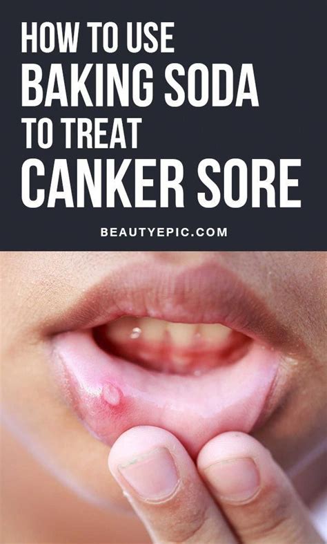 Baking Soda For Canker Sore Relief Effective Remedies To Try At Home