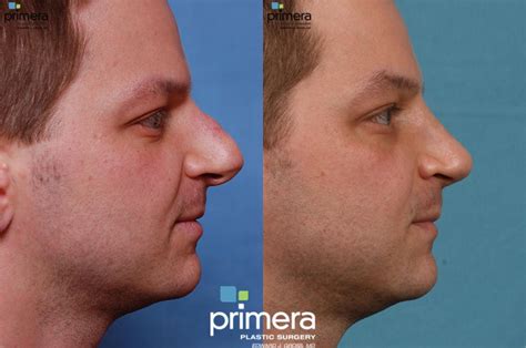 Rhinoplasty Before And After Pictures Case 21 Orlando Florida