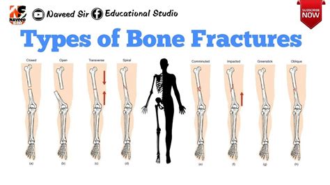 5 Different Types Of Fractures
