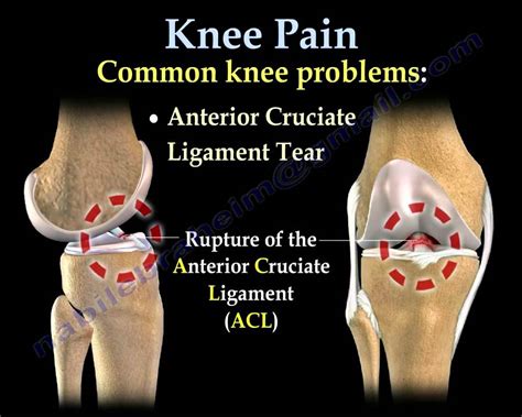 Knee Pain Common Causes Everything You Need To Know Dr Nabil Ebraheim