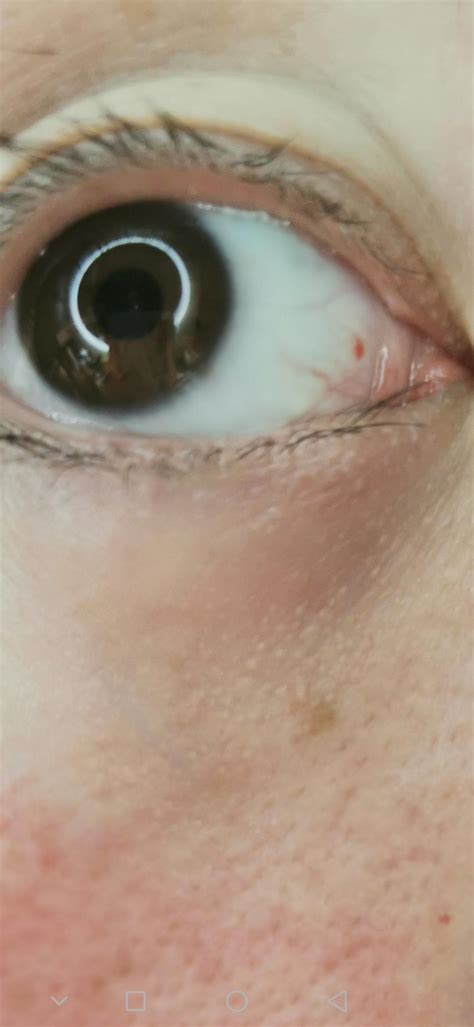 Red Spot On Eye What Is It Has A Ring Around It Optometry