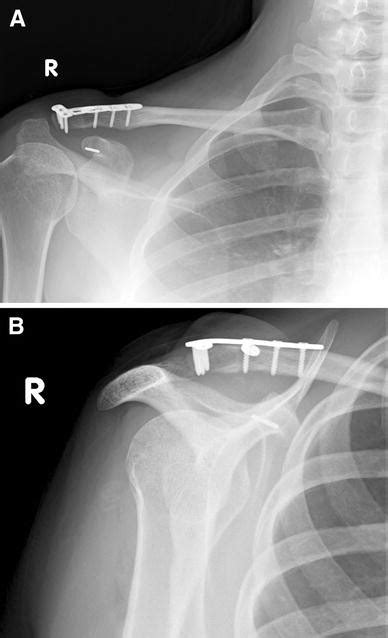 Treatment Of Neer Type Ii Fractures Of The Lateral Clavicle Using