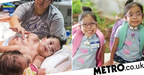 Conjoined Twins Separated After Huge Surgery Thrived And Have Started