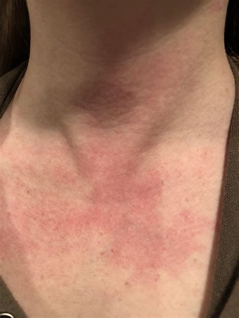Randomly Occurring Rashy Looking Discoloration On Neck And Chest