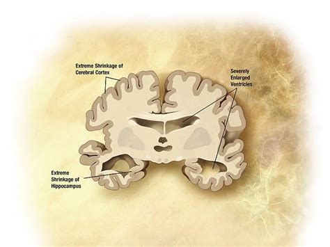 memory loss associated with alzheimer s reversed for first time neuroscience news