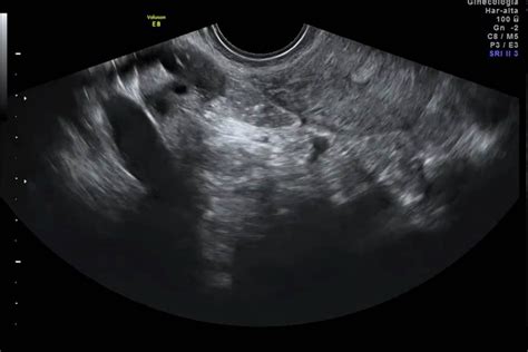 Ultrasonido Ginecológico útero Y Ovarios Villestory