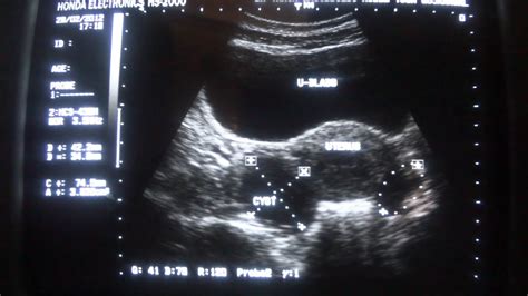 Ultrasound Female Pelvic Region Cystic Areas Youtube
