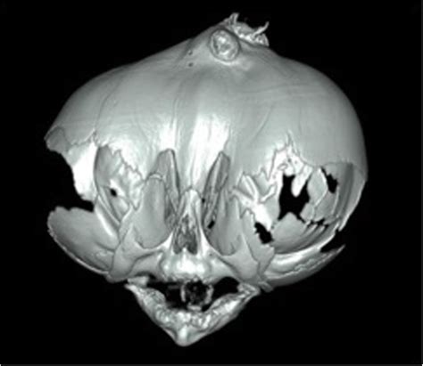Cloverleaf Skull Craniosynostosis Pacs