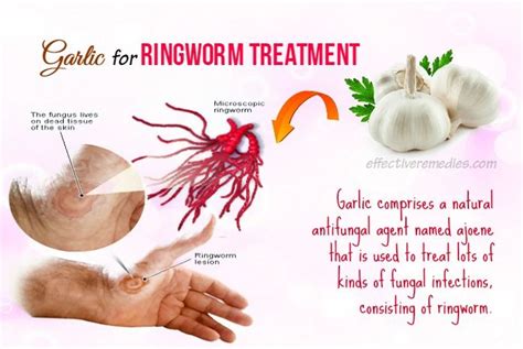 15 Best Natural Home Remedies For Ringworm In Humans Ringworm
