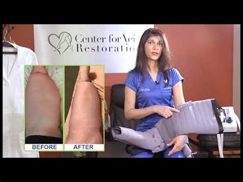 What To Do About Lymphedema YouTube