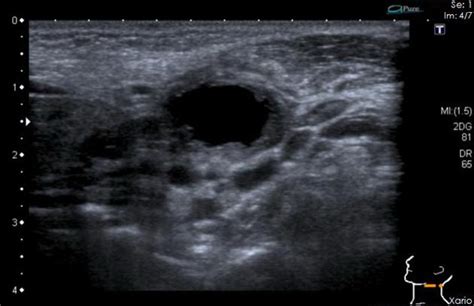 Branchial Cleft Cyst Ultrasound