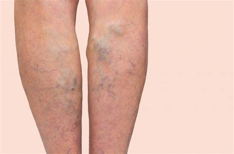 Varicose Veins Causes Symptoms Removal And Treatments Auckland Nz