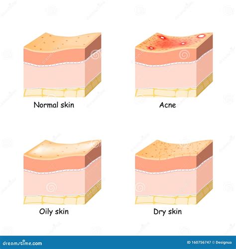 Normal Dry Oily Younger And Older Skin Sectional View Cartoon