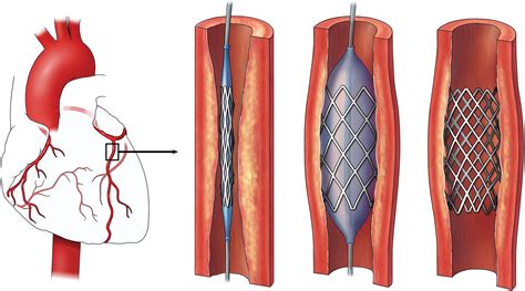 Improving Post Heart Attack Stent Surgery Cardiology