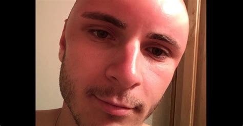 Sunburn Leads To Dent In Mans Forehead Rare