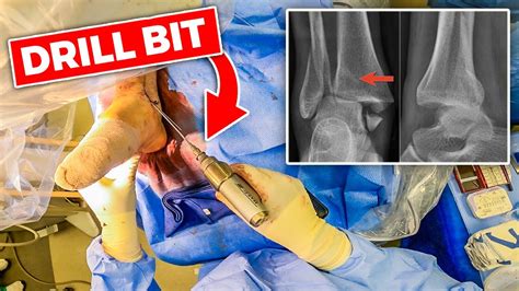 Inside The Or Ankle Fracture Open Reduction Internal Fixation