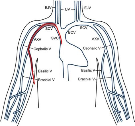 This Image Shows The Position Of The Picc And Where Thr Open I