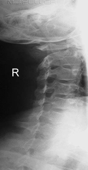 Trauma Obliques Of The Cervical Spine Wikiradiography