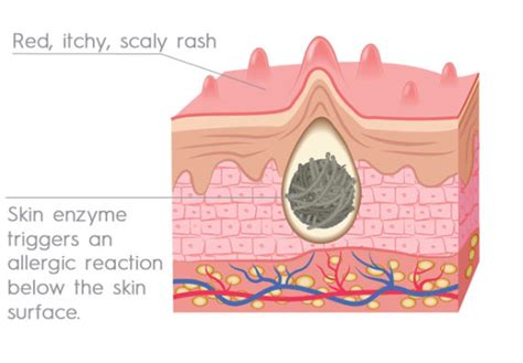 Stem Cell Therapy For Eczema