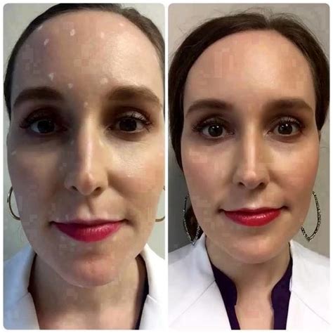 Botox Before And After Pics Forehead 12 Facelift Info Prices