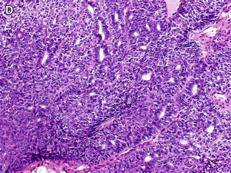 Update On Malignant Sweat Gland Tumors Surgical Pathology Clinics