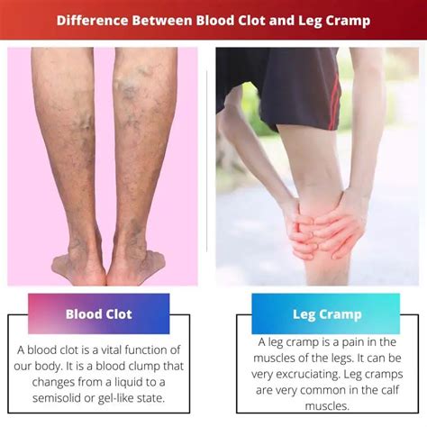 Blood Clot Vs Leg Cramp Difference And Comparison