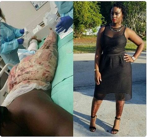 Months After Suffering From Fire Burns See What This Lady Looks Like