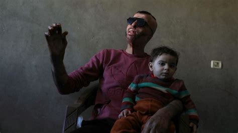 Gaza Burn Victims Get 3d Printer Face Masks Made Close To Home The