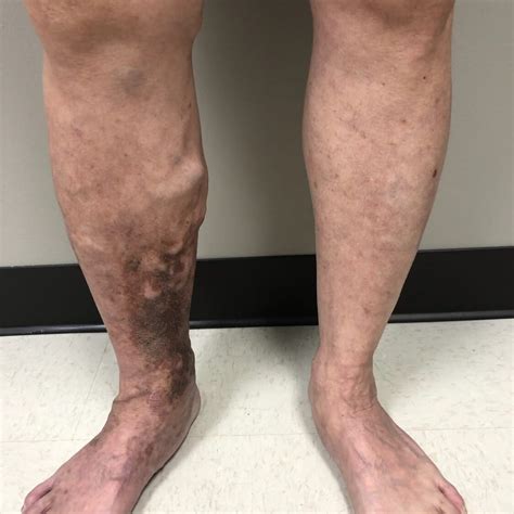 Leg Discoloration Vein Institute Surgical Associates Of Houston