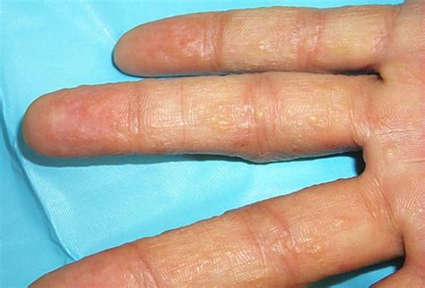 Slideshow The Many Faces Of Eczema In Hands Hand Facts News About