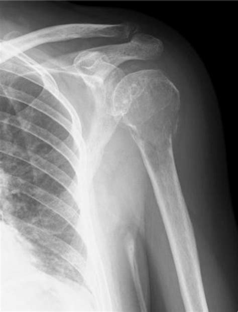 Anteroposterior Radiograph Of The Left Shoulder Shows A Pathological