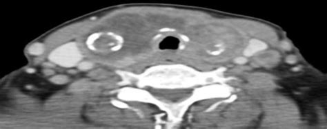 Ct Showing Hypodense Mass Occupying Right Thyroid Gland Across The
