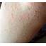 Cold Urticaria Causes Symptoms Diagnosis And Treatment  Natural