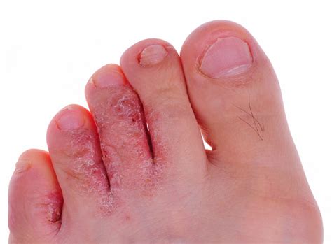 Athletes Foot Tinea Pedis My FootDr