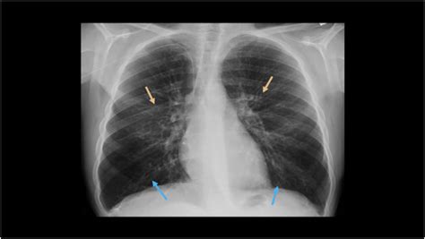 Cystic Fibrosis In The St Century What Every Radiologist Should Know
