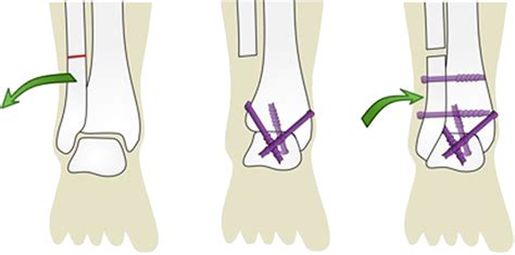 Technical Guide Transfibular Ankle Arthrodesis With Fibular Onlay
