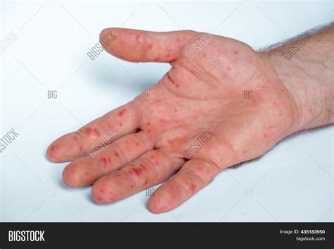 Painful Rash Red Image And Photo Free Trial Bigstock