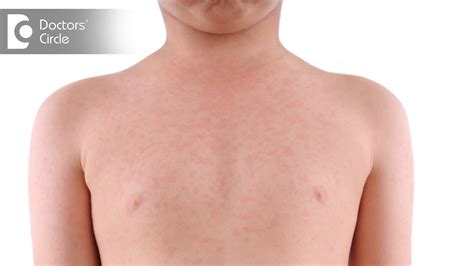 What Causes Fever Body Rash With Headache And Its Management Dr