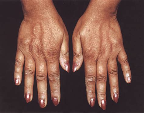 Eczematous Changes On The Hands—quiz Case Dermatology Jama